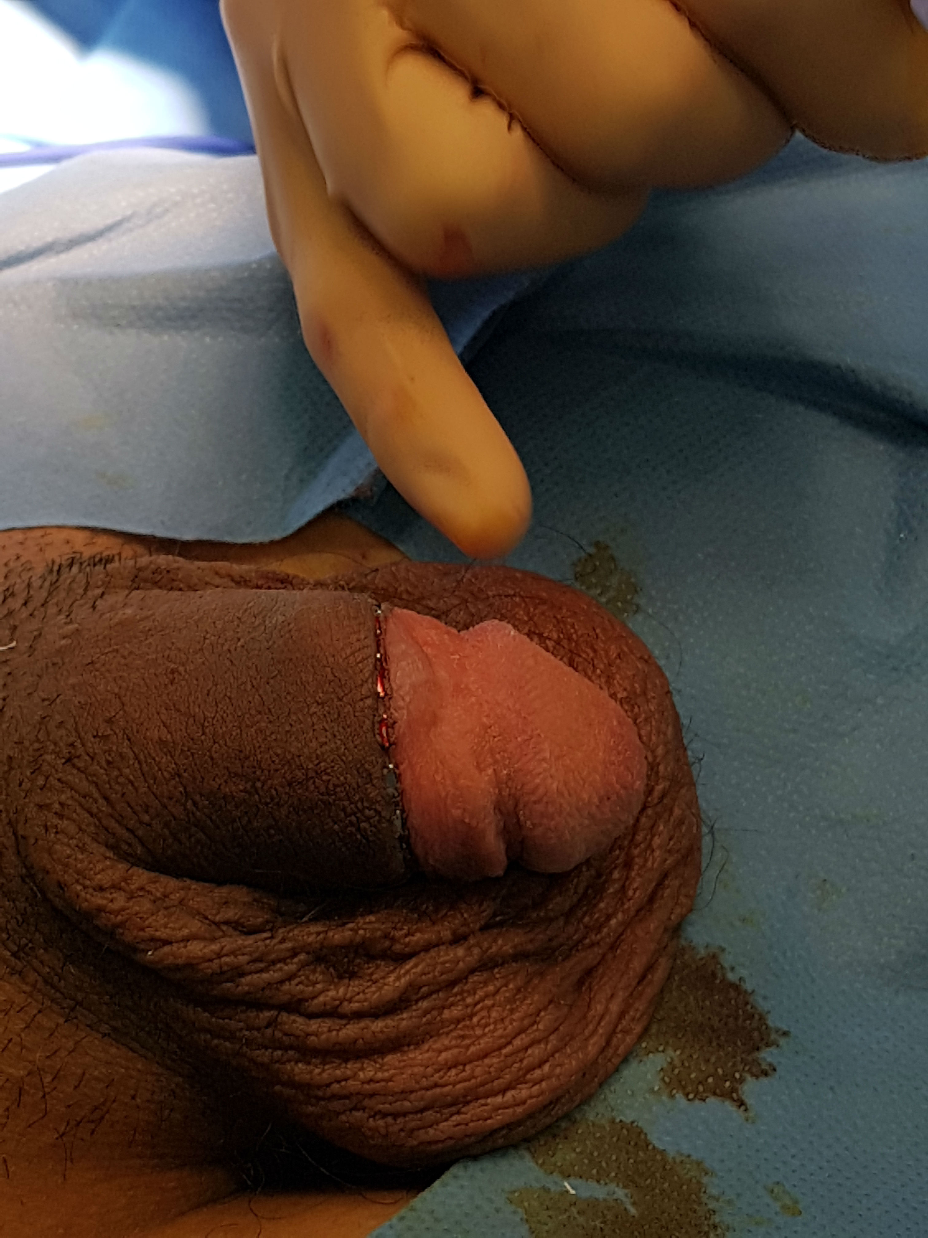 15-year-old french phimosis patient-3.jpg